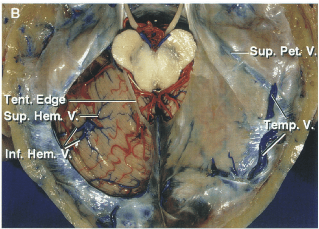 The left half of the tentorium has been removed while preserving the tentorial edge.