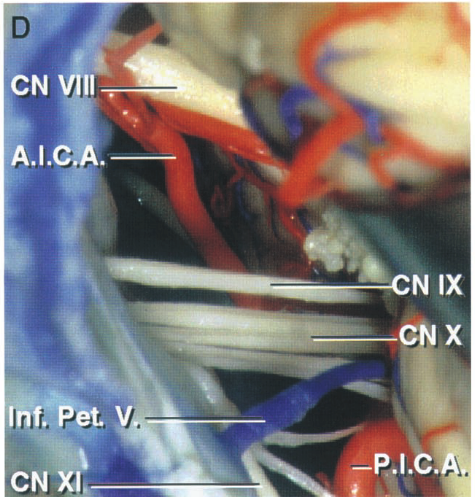 Posterior views into cerebellopontine angle