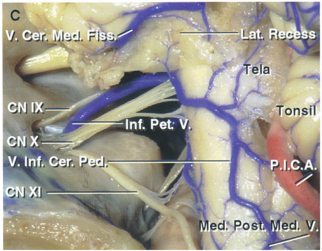 Posterior views into cerebellopontine angle