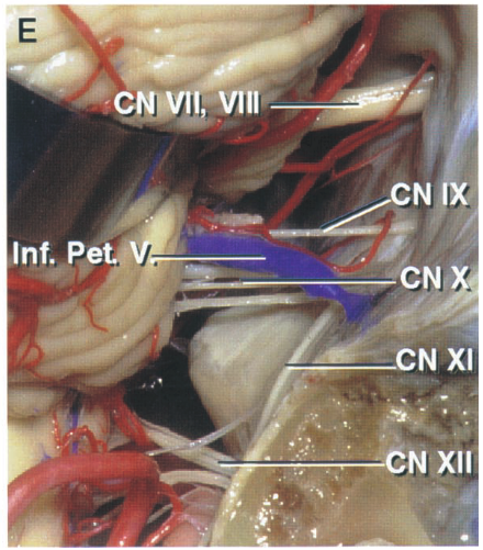 Posterior views into cerebellopontine angle