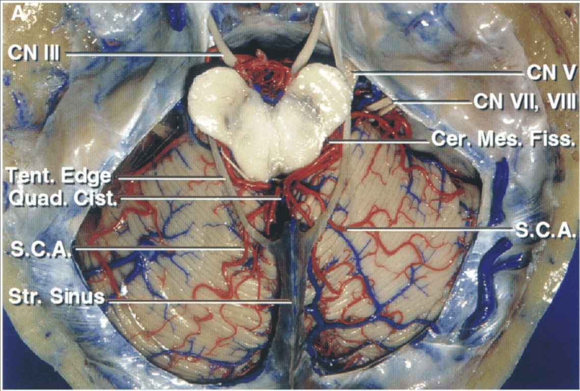 The SCA, cerebellomesencephalic fissure, and tentorial surface superior views