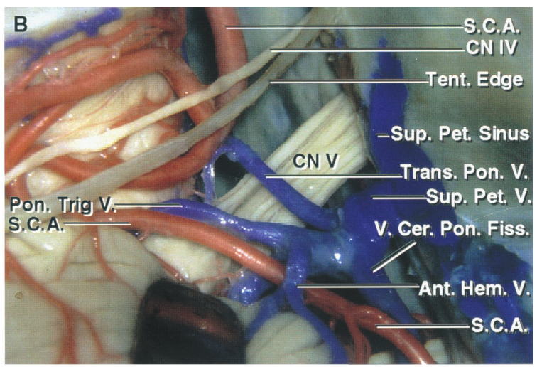 Lateral view of a large superior petrosal vein formed by the union of the transverse pontine, pontotrigeminal, and anterior hemispheric veins and the vein of the cerebellopontine fissure. 