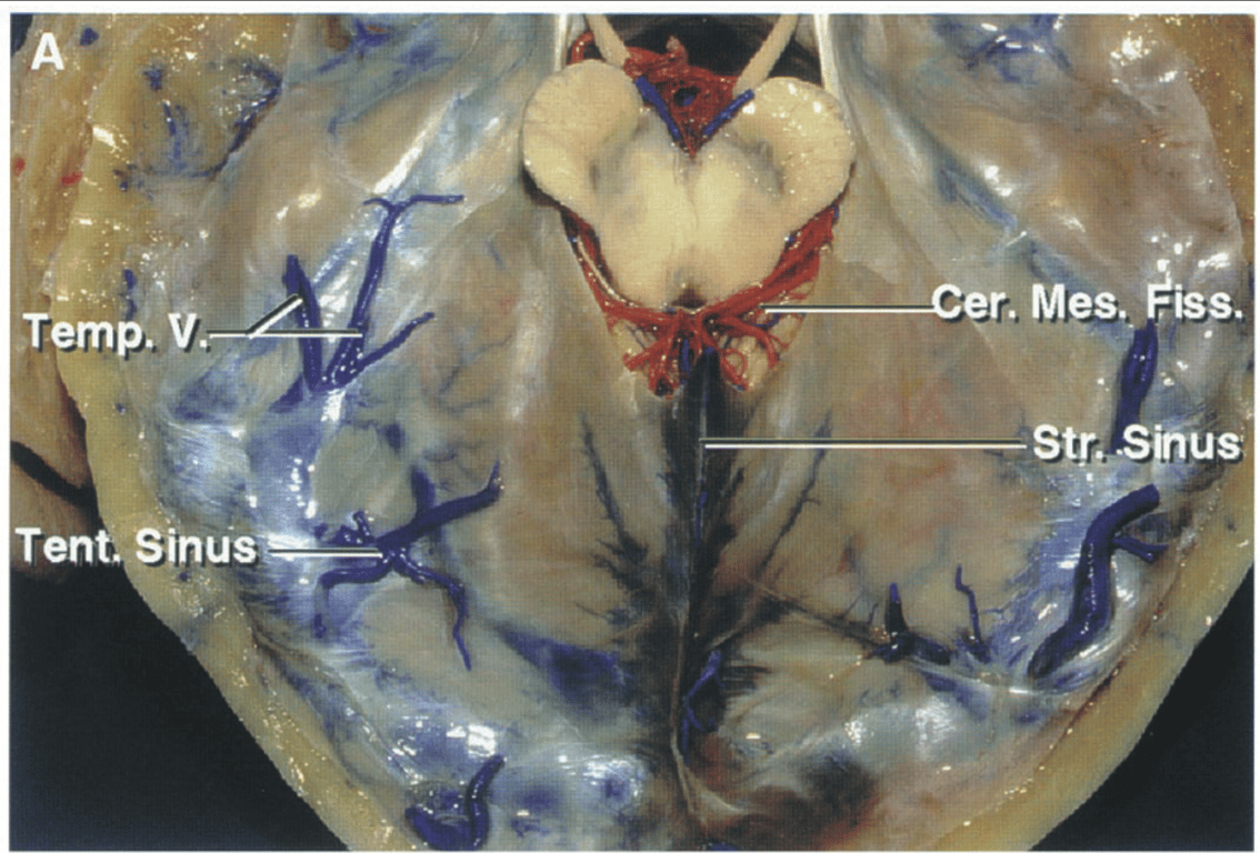 Superior surface of the tentorium