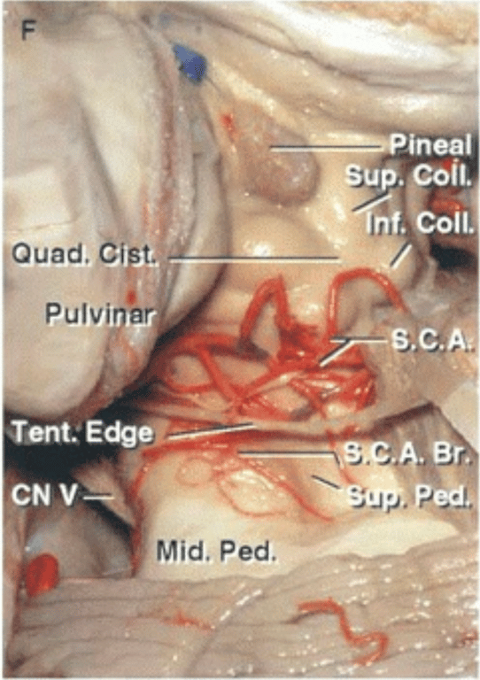 Oblique posterior view of the SCA branches within the cerebellomesencephalic fissure and the quadrigeminal cistern. 