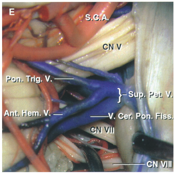 The vestibulocochlear nerve has been depressed to expose the facial nerve.