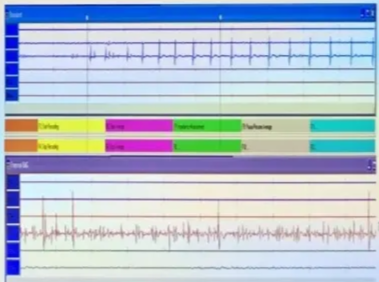 Queen Square Review— EMG firing Phasic/burst pattern: rarely neural damage Tonic/train activity: serious neural insult often post-op deficit 