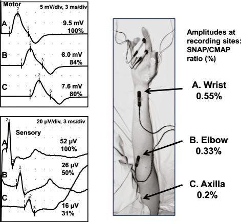 c 9.5mv 8.0 mv 7.6 mv 52 100% 26 uv 16 PV 31% Amplitudes at recording sites SNAP/CMAP ratio (%) A. Wrist 0.55% B. Elbow 0.33% C. Axilla 0.2% 