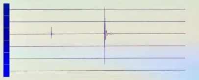 Queen Square Review— EMG firing Phasic/burst pattern: rarely neural damage Tonic/train activity: serious neural insult often post-op deficit 