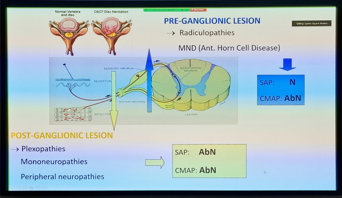 Normal Vertebra and disc C61C7 Disc Herniation SENSORY NEURON RECEPTOR MOTOR NEURON EFFECTO PRE-GANGLIONIC LESION —y Radiculopathies MND (Ant. Horn Cell Disease) ASSOCIATION NEURON SAP: Ta&g: Queen Square Reheww CMAP: AbN POST-GANGLIONIC LESION —y plexopathies Mononeuropathies Peripheral neuropathies CENTER SAP: AbN CMAP: AbN 