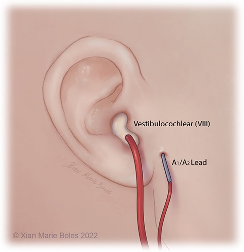 Vestibulocochlear (Vlll) Al/A2 Lead O Xian Marie Boles 2022 