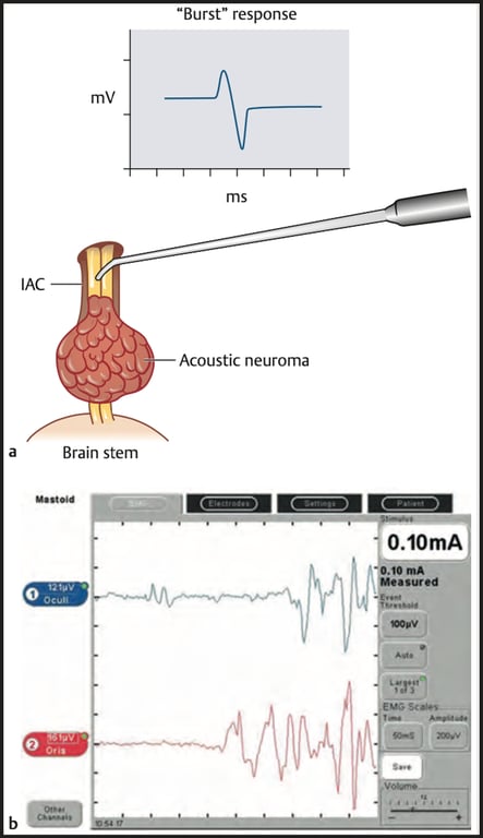 a "Burst" response Acoustic neuroma Brain Stem 0.10mA 