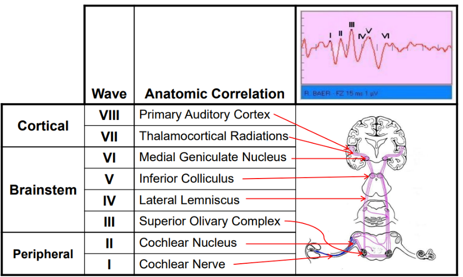 Wave Vill Cortical Vil VI V Brainstem IV Peripheral Anatomic Correlation Primary Auditory Cortex Thalamocortical Radiation Medial Geniculate Nucleus Inferior Colliculus Lateral Lemniscus Superior Olivary Complex Cochlear Nucleus Cochlear Nerve 