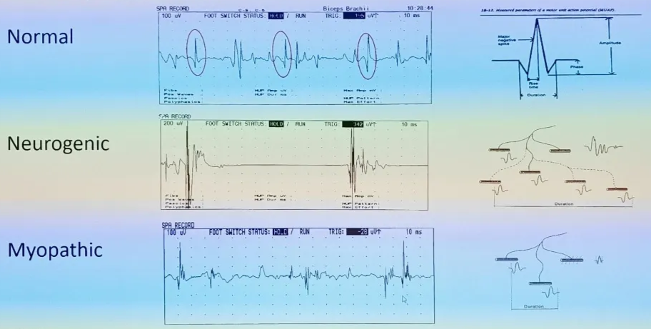 EMG patterns SVITCH STATUS Normal sutTCH STATUS aic. s TRIG. TRIG Brachii 100 uv 200 uv Neurogenic SPR RECOR u Myopathic FOOT FOOT u Ta&g: Queen Review— 1098 •44 10 ms 10 ms ms Ouratlon 