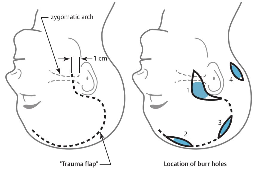 zygomatic arch 1 cm "Trauma flap" Location of burr holes 