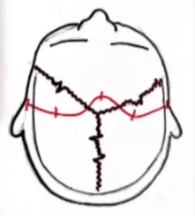 Multiple burr holes diagram AI-generated content may be incorrect.