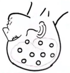 Multiple burr holes diagram AI-generated content may be incorrect.