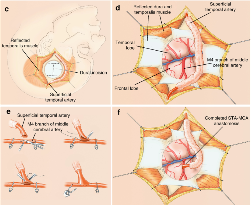 tenpora/is rusc& temporal artery tertvoral artery M4 tranch cerebral artery Clara and temporalis muscle Temporal incision Frontal lobe temporal artery MA braæ•t of midde artery Completed STA-MCA 