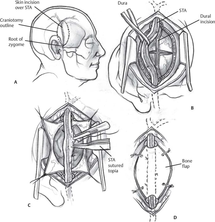 Encephaloduroarteriosynangiosis | Neupsy Key