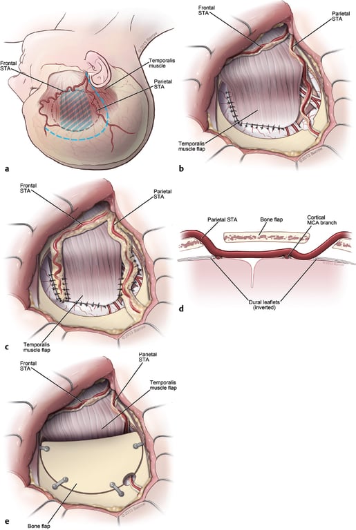 10 Pediatric Moyamoya Disease | Neupsy Key