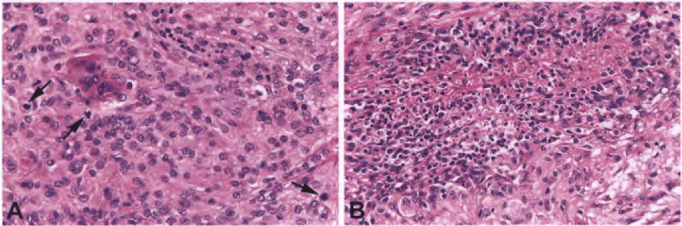 Atypical meningioma. (A) Atypical meningioma is most reliably identified by increased mitotic activity (arrows). Note the absence of nuclear atypia in this example. (B) The micronecrosis seen in this image is considered spontaneous in that it was not iatrogenically induced (e.g. by embolization).