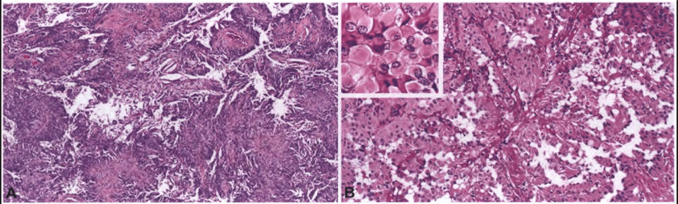 Papillary meningioma. (A) At low magnification, the pseudopapillary pattern is evident, with loss of cellular cohesion away from central vascular cores. (B) This meningioma combines a papillary growth pattern with rhabdoid cytology, including globular paranuclear inclusions (inset).