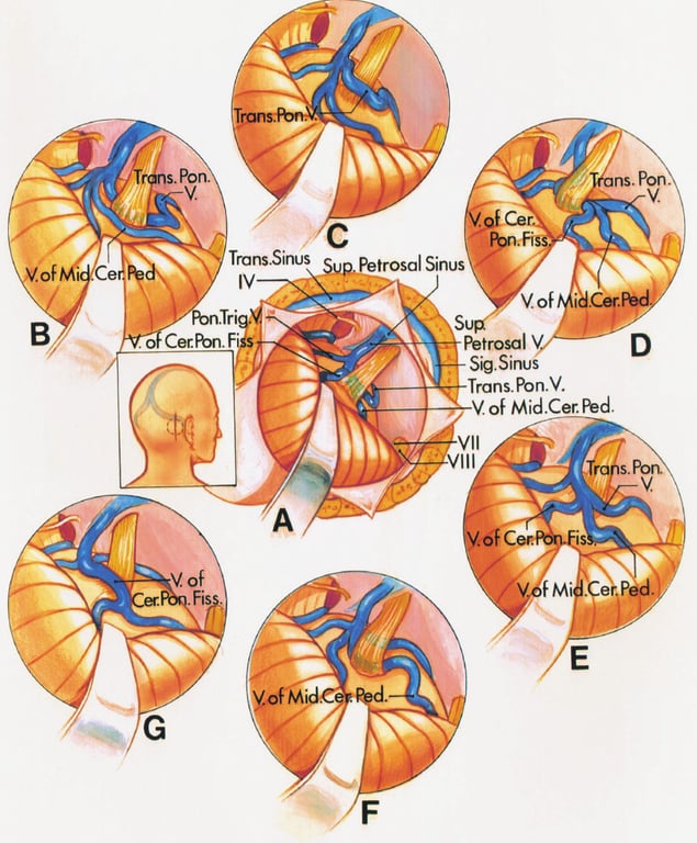 TransSirws . of Tri Cer.R)n. F V. of Petrosal Sinus ns. Pon. Cer. V.of i C«. Petrosal V Sig. Sirws Trans. pon.V. V.of Mid.Cer.Ped. Vil Vill s. Pon e. 