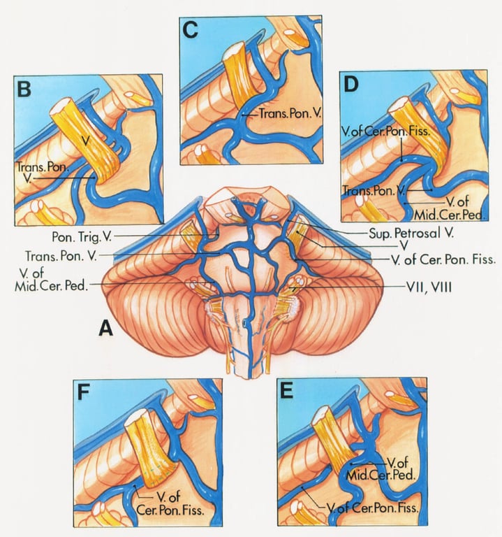 rans. Pon. Trig. V. Trans. Pon. V V. of Sup. Petrosal V. V. of Cer. Pon. Fiss. Mid.Cer. Ped. Vil, Vill 