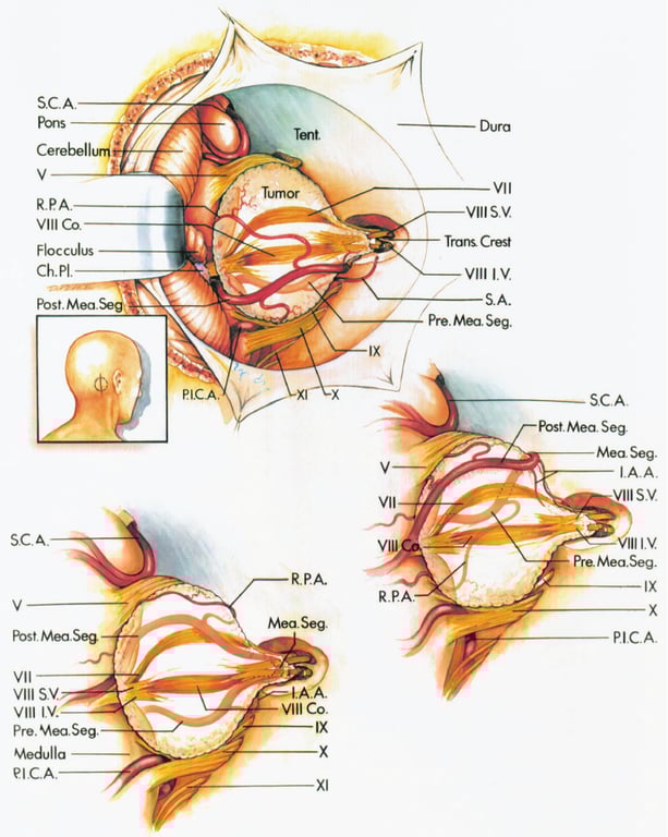 Posterior views via retrosigmoidal approach 