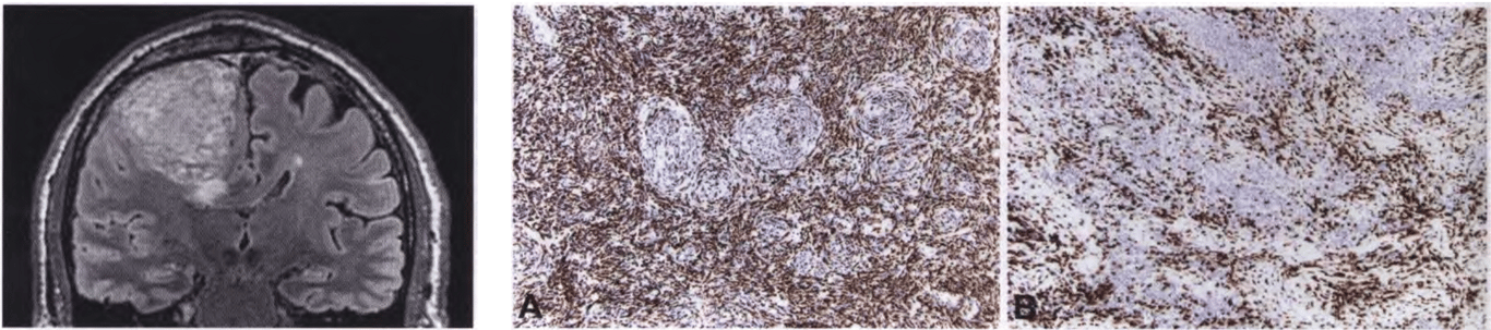 (Fig. on the left) Lymphoplasmacyte-rich meningioma. Signal heterogeneity on FLAIR MRI likely corresponds to pockets of inflammation. (A) Macrophages immunoreactive for CD68 are the dominant inflammatory component. Note the immunonegative meningothelial nests. (B) Immunostaining for CD3 shows abundant reactive T cells.