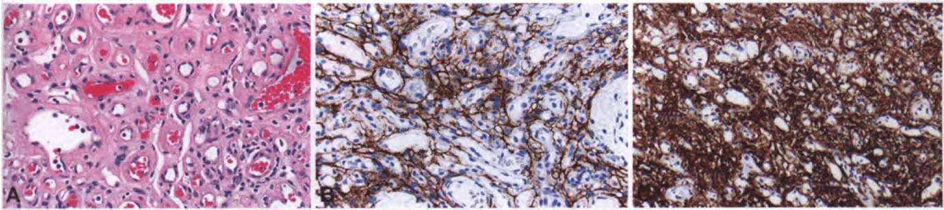 Angiomatous meningioma. (A) Blood vessels constitute most of the mass. The intervening tumour cells are difficult to recognize as meningothelial. (B) Tumour cells showing positivity for EMA. (C) Strong immunoreactivity for somatostatin receptor type 2A.