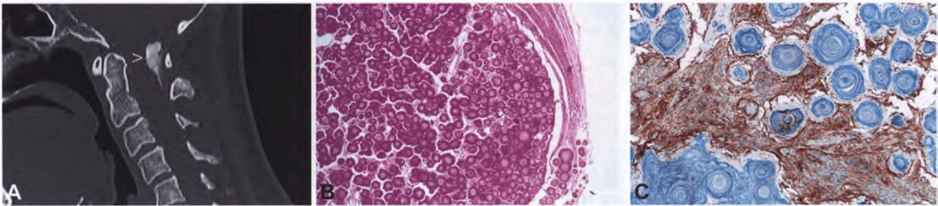 Psammomatous meningioma. (A) CT showing bone-like density of a psammomatous meningioma (arrowhead) involving the cervicomedullary junction. (B) Almost complete replacement of the meningioma by psammomatous calcifications (postdecalcification specimen). (C) EMA immunostaining reveals meningioma cells between psammoma bodies.