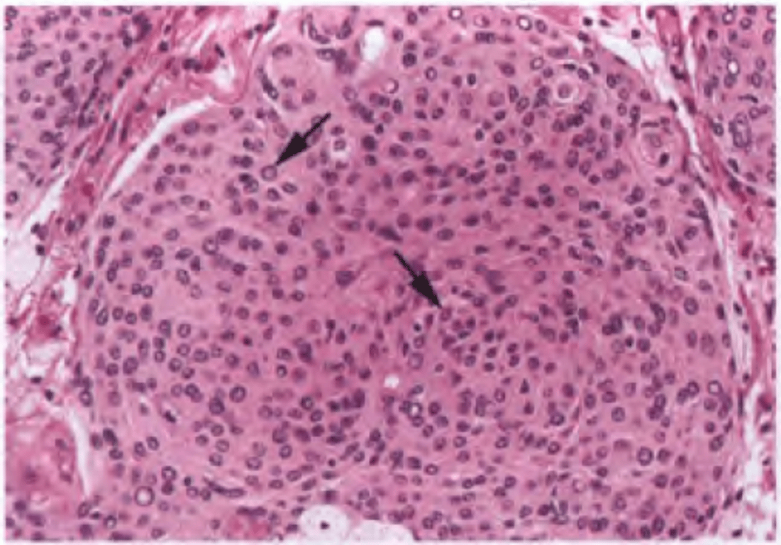 Meningothelial meningioma with lobular growth pattern, syncytium-like appearance due to poorly defined cell borders, scattered clear nuclear holes, and occasional intranuclear pseudoinclusions (arrows).