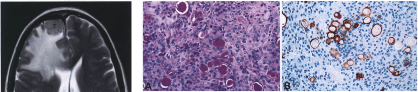 (Fig. on the left) Small secretory meningioma (T) on T2-weighted MRI, showing extensive peritumoural brain oedema. (A) The pseudopsammoma bodies are periodic acid-Schiff-positive. (B) Evidence of epithelial metaplasia includes cytokeratin positivity in tumour cells forming gland-like spaces.