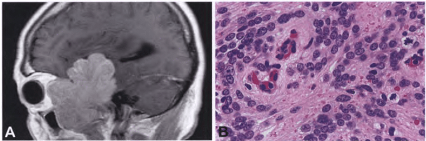 Papillary meningioma. (A) Postcontrast T1-weighted MRI. Occasional papillary meningiomas feature a cauliflower-like imaging appearance. (B) Nucleus-free perivascular zone resembling the pseudorosette of an ependymoma; the additional presence of mitotic figures is evident on the right.