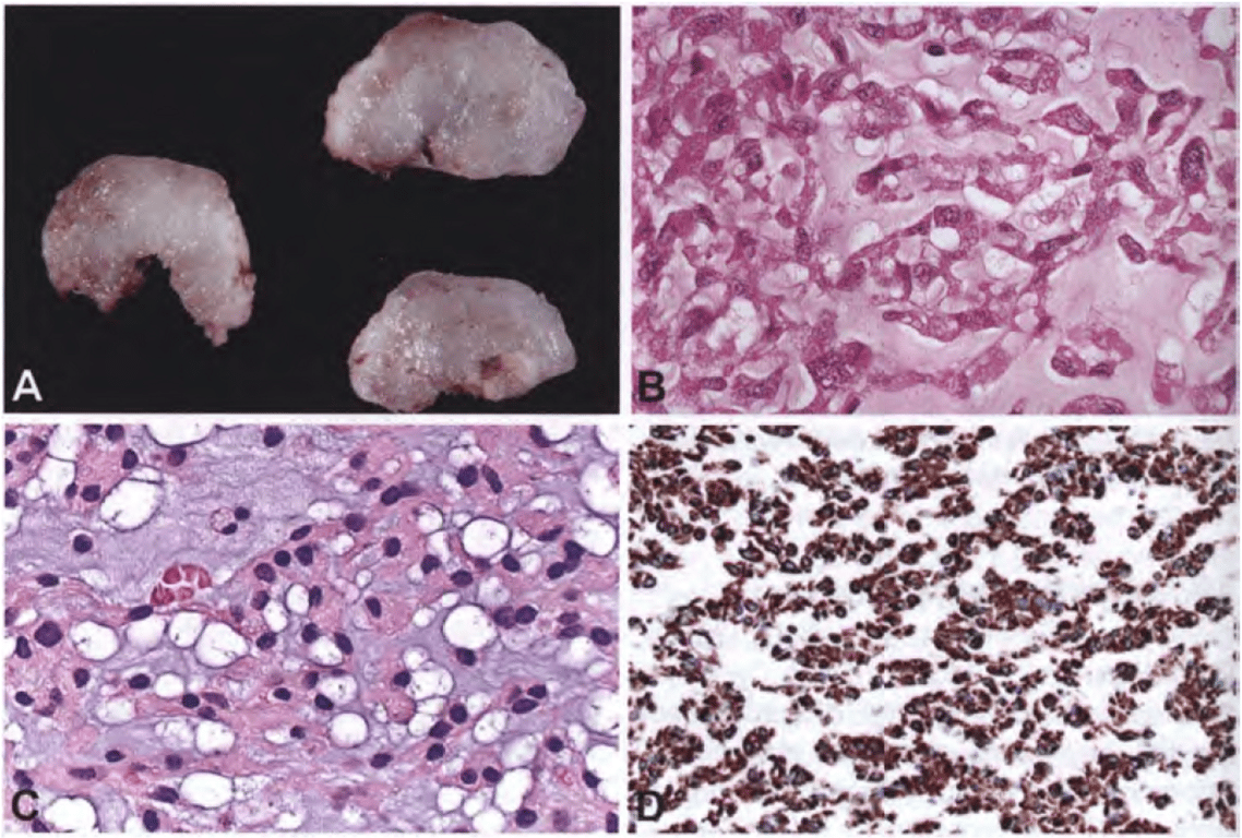 Chordoid meningioma. (A) On cut surface, the mucoid matrix is grossly evident. (B) Eosinophilic tumour cells in a mucous-rich matrix. (C) Trabeculae of eosinophilic and vacuolated epithelioid cells associated with a basophilic mucin-rich stroma. (D) Vimentin immunohistochemistry highlights the ribbon-like architecture.