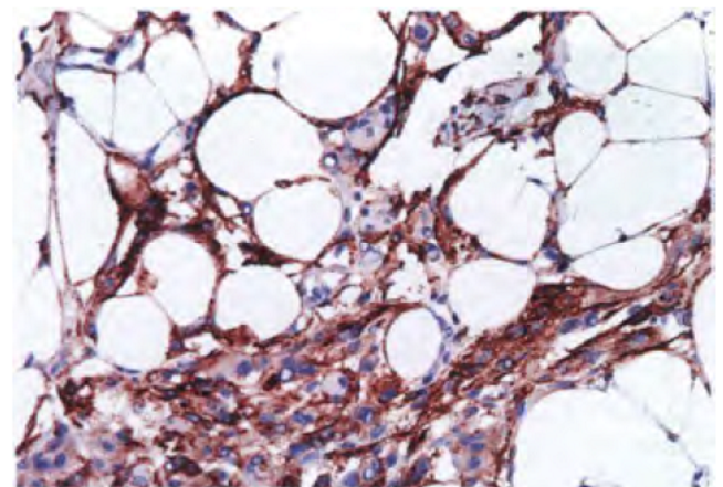 Lipoma-like metaplastic meningioma. Positivity for EMA in lipoma-like cells suggests fat accumulation in meningioma cells rather than true adipocyte metaplasia.