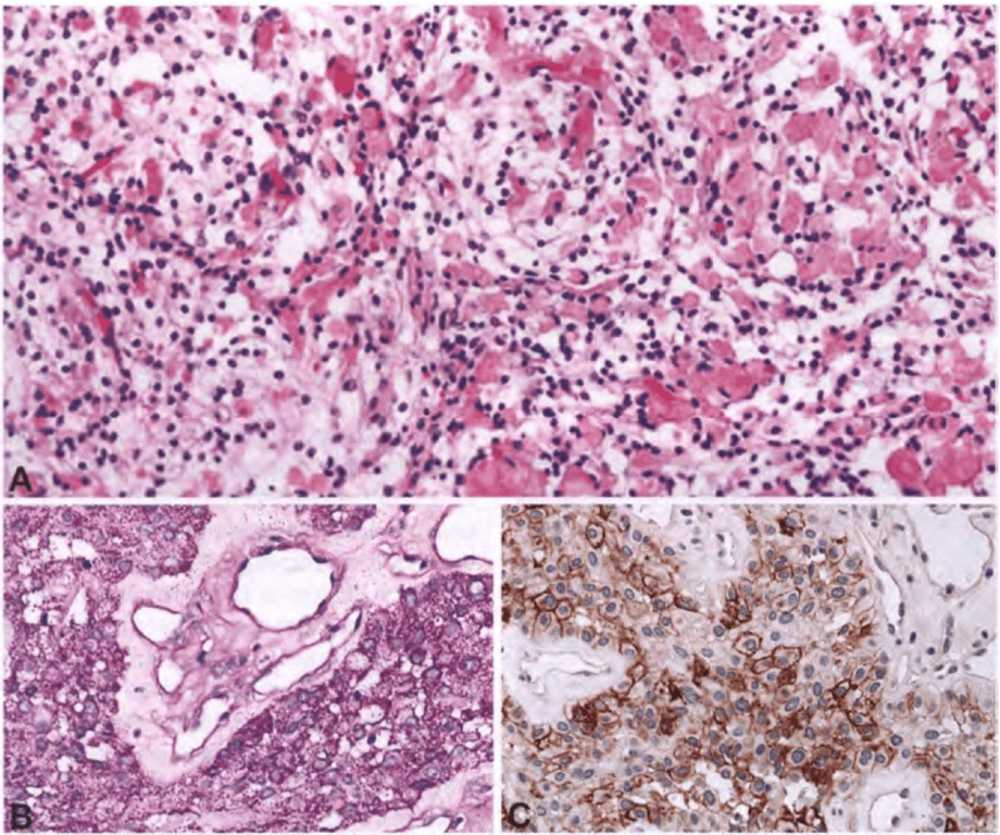 Clear cell meningioma. (A) Sheets of rounded clear cells and perivascular interstitial collagenization. (B) Abundant periodic acid-Schiff-positive intracytoplasmic glycogen. (C) Immunoreactivity for EMA.
