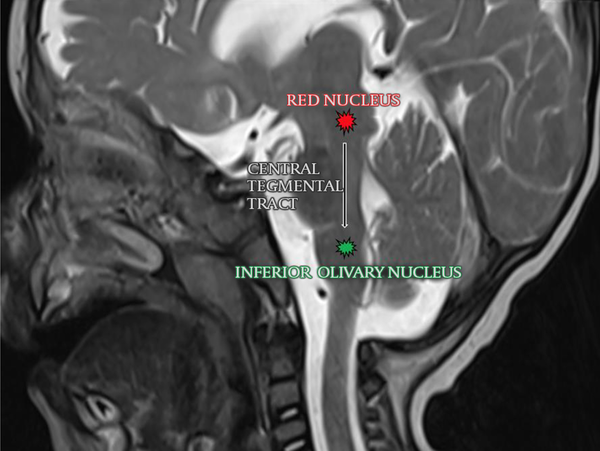 The central tegmental tract is located in tegmentum pontis between the red nucleus and the inferior olivary nucleus.