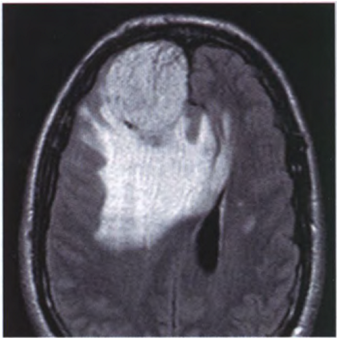 Angiomatous meningioma on FLAIR MRI, showing marked peritumoural brain oedema.
