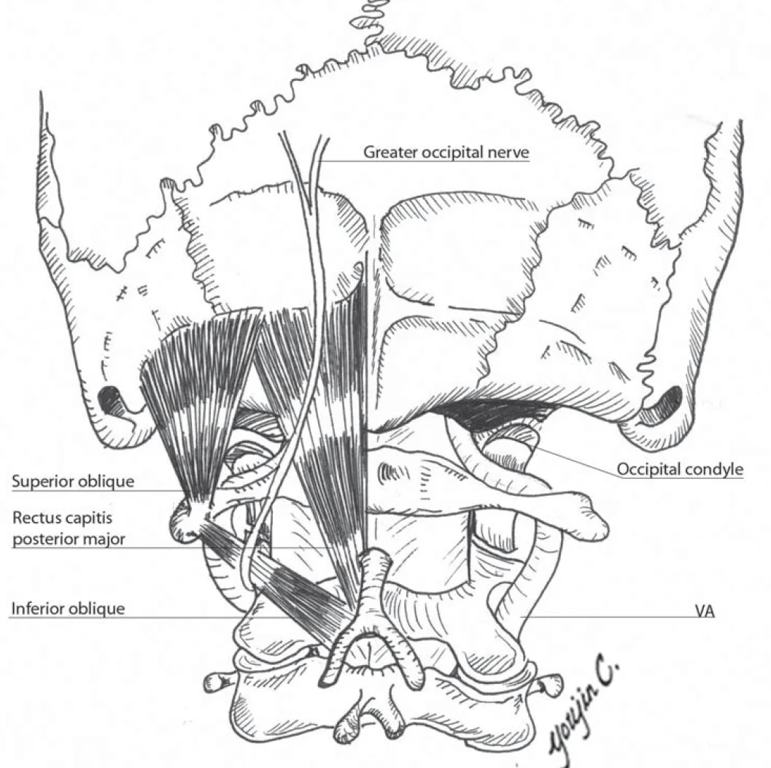 Suboccipital triangle. The third segment of the vertebral artery (VA) courses from the foramina transversaria (FT) of C1, then along the lateral lamina of C1 to sit in the fat of the floor of the suboccipital triangle. It reaches the sulcus arteriosus (SA) of C1 and then courses in a superior and medial direction to pierce the dura medial to the occipital condyle. The rectus capitis posterior major sits deep to the rectus capitis posterior minor, which arises from the C1 and inserts along the midline and inferior to its major counterpart.