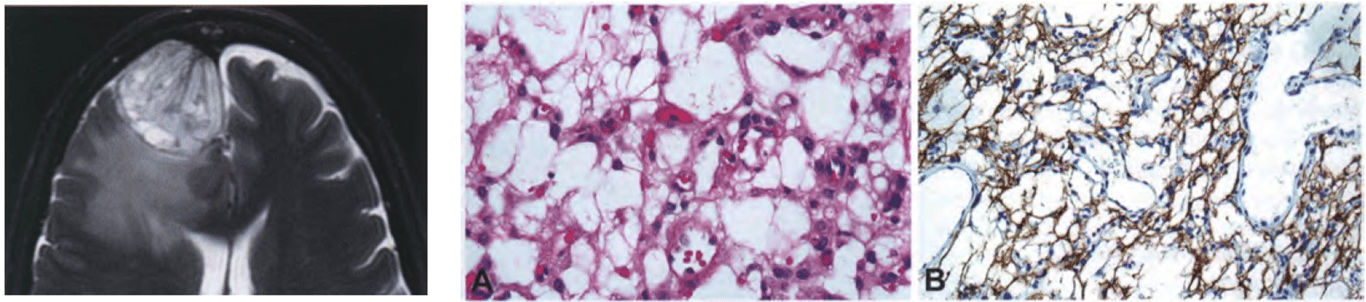 (Fig. on the left) Microcystic meningioma on T2-weighted MRI, with macrocysts and adjacent brain oedema. (A) Cobweb-like background with numerous delicate processes. (B) Thin processes are often evident on EMA immunostaining.