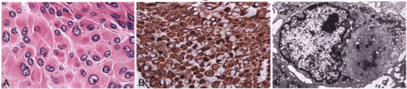 Rhabdoid meningioma. (A) Eccentrically placed vesicular nuclei, prominent nucleoli, and eosinophilic globular/fibrillar paranuclear inclusions. (B) Vimentin-positive paranuclear inclusions. (C) Rhabdoid meningioma cell showing a paranuclear whorled bundle of intermediate filaments with entrapped organelles.
