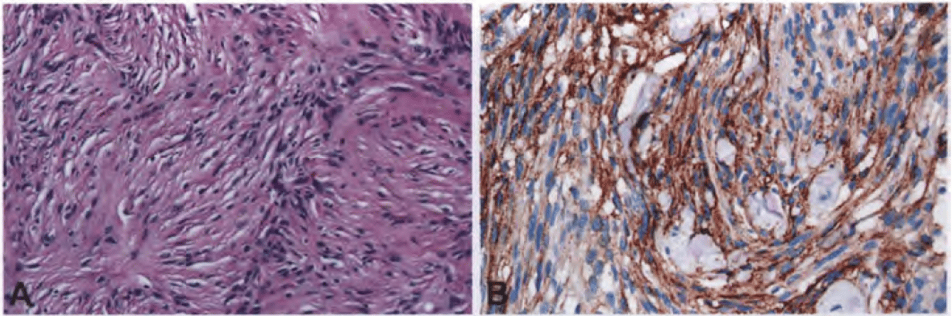 Fibrous meningioma. (A) A distinctive feature of this variant is the development of abundant reticulin and collagen fibres between the individual cells. (B) Most fibrous meningiomas express EMA.