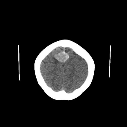 A ct scan of a brain AI-generated content may be incorrect.