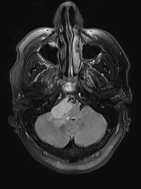 A close-up of a mri scan AI-generated content may be incorrect.