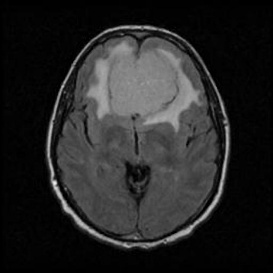 A close-up of a brain scan AI-generated content may be incorrect.