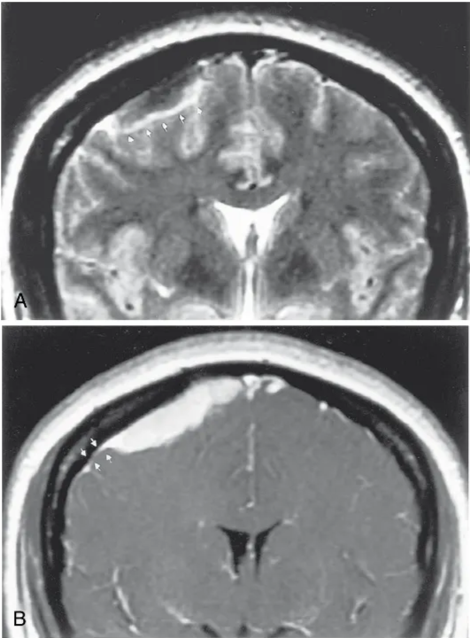 FIGURE 3-3. Parasagittal meningioma. A, This meningioma is really dark on T2-weighted image but the adjacent bright cerebrospinal fluid (CSF) demonstrates its extra-axial location nicely (CSF cleft sign designated by arrows). B, Add a dural tail (arrows) and strong enhancement, and you should be dictating this case as a meningioma. 