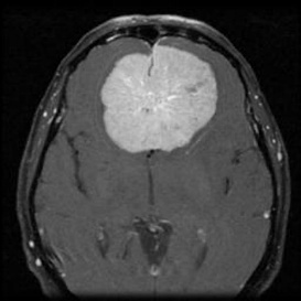 A mri of a brain AI-generated content may be incorrect.