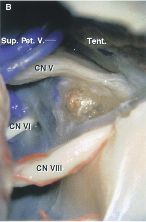 sup. V.— CNV CN Vill Tent. 