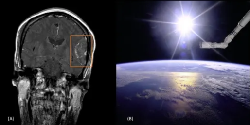 Sunburst appearance. T1 weighted brain MRI, coronal view (A), left parietal hemisphere lesion with spoke wheel pattern of vessels supplying a meningioma. This characteristic vascular supply resembles a sunburst (orange rectangle). (B) View of the Remote Manipulator System (RMS) end effector over an Earth limb with a solar sunburst pattern behind it. By NASA (Great Images in NASA Description) [Public domain], via Wikimedia Commons. 